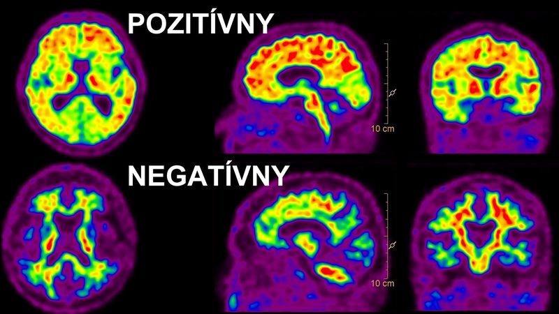 The definitive end of the wonder drug for dementia?