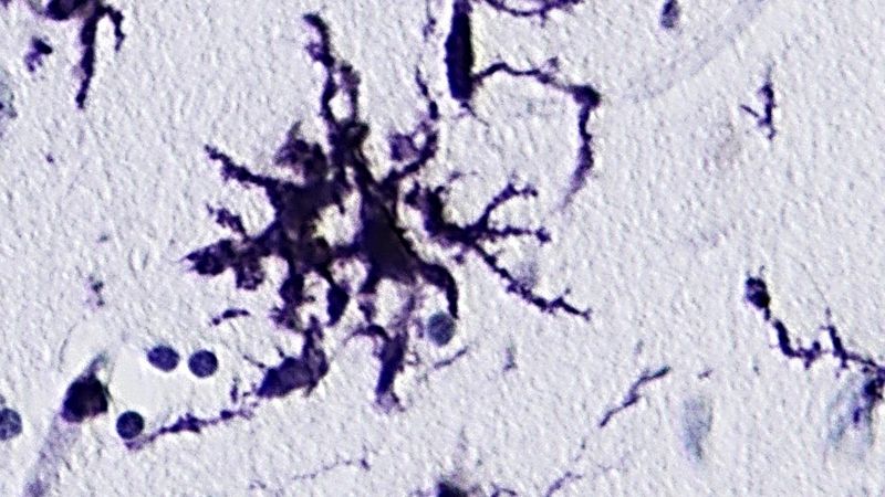 Sclerosis multiplex: angry immunity in the brain